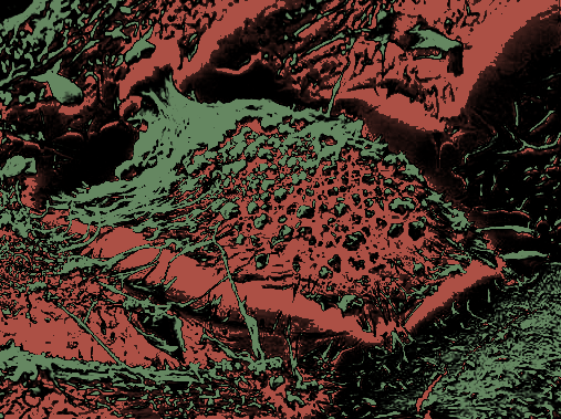 Tritone image of lung cancer cell.